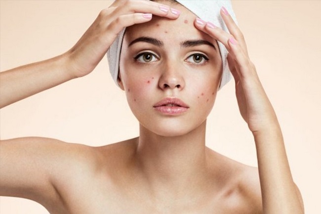 Thêm một thuốc mới giúp trị mụn trứng cá Thêm một thuốc mới giúp trị mụn trứng cá