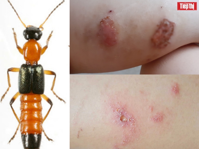 Xử lý khi bị kiến ba khoang cắn trong mùa giãn cách